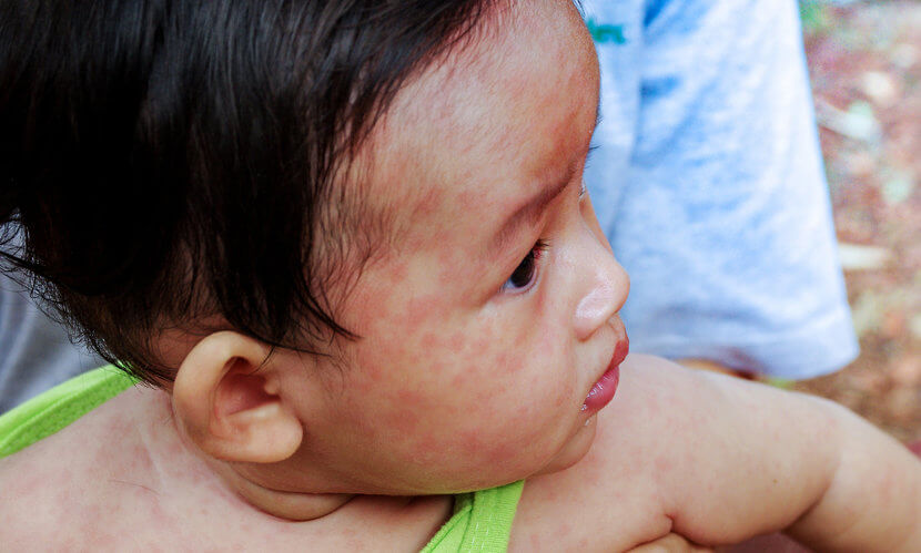 O sarampo é uma doença grave que causa a morte de muitas crianças todos os anos.