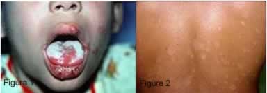 Figura 1. Sapinho na boca. Figura 2. Pano branco